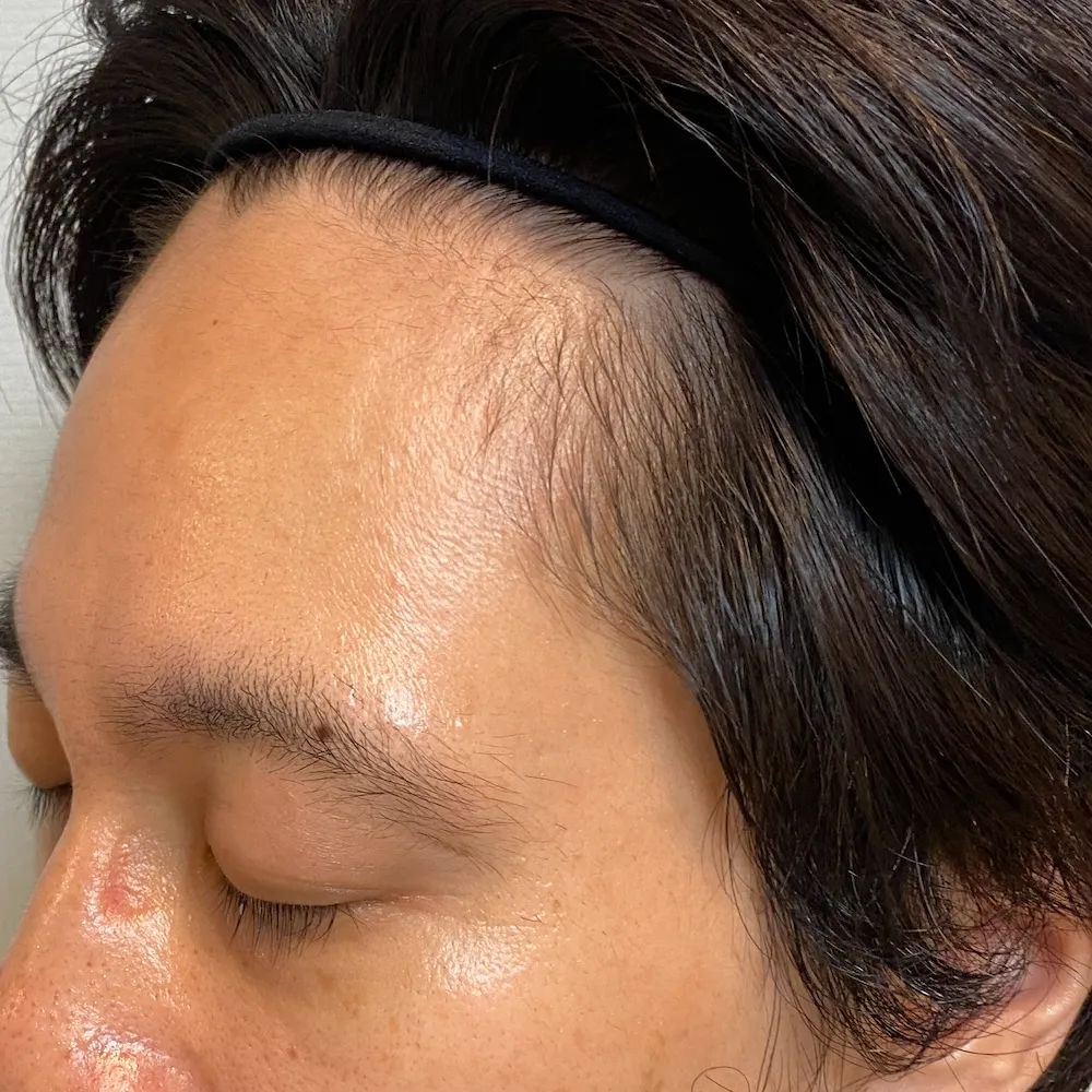 額の生え際(左)