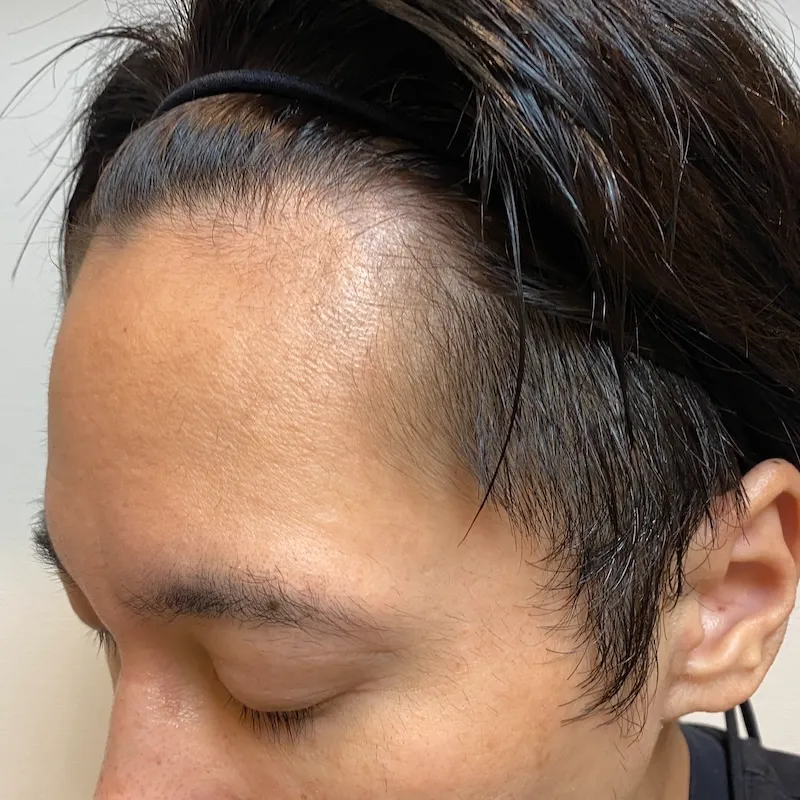 額の生え際(右)