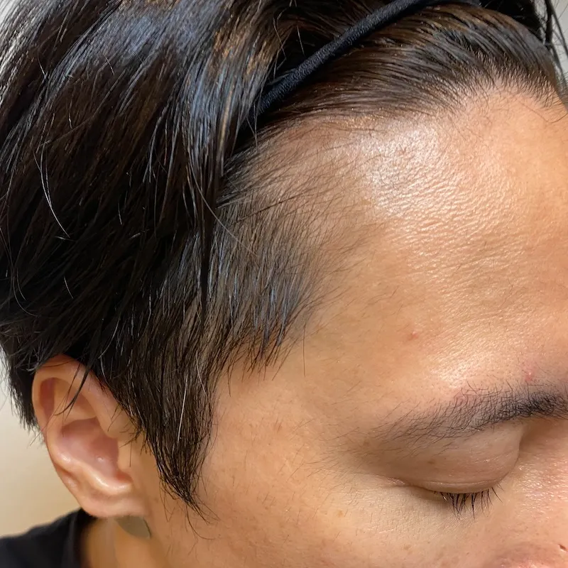 額の生え際(左)